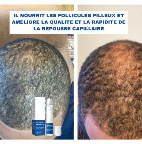 🌿 SÉRUM ROLL-ON CROISSANCE DE CHEVEUX – Homme&Femme🇺🇸 🇬🇦